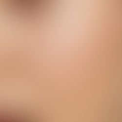 Professional dermaplaning treatment being performed at Clinic4O2 in Takanini, Auckland