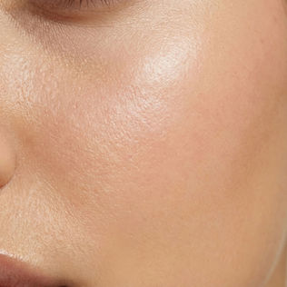 Professional dermaplaning treatment being performed at Clinic4O2 in Takanini, Auckland