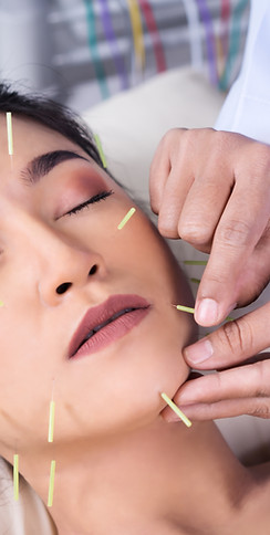 Acupuncture