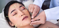 Acupuncture