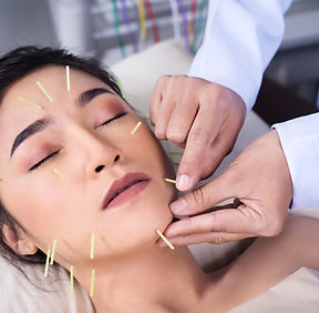 Acupuncture