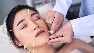 Acupuncture
