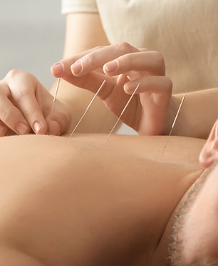 Acupuncture