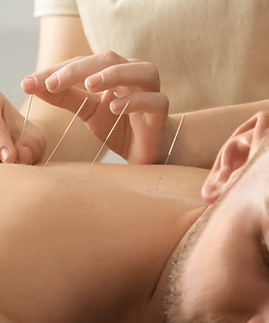 Acupuncture