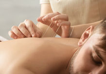 Acupuncture on back at A to zen city therapies near London Bridge