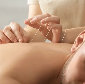 Acupuncture Session