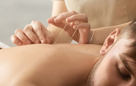 Acupuncture