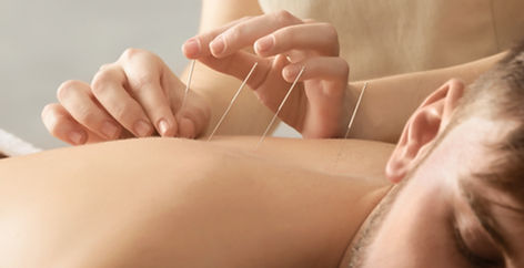 Acupuncture Session