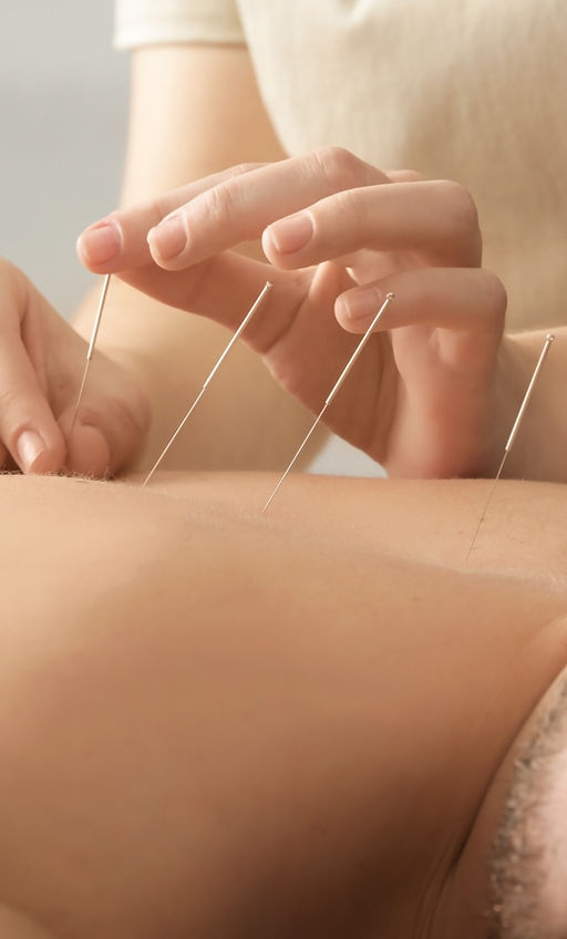 Acupuncture