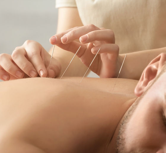 Acupuncture
