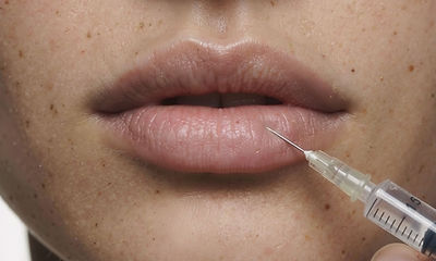 Lip Injection Procedure