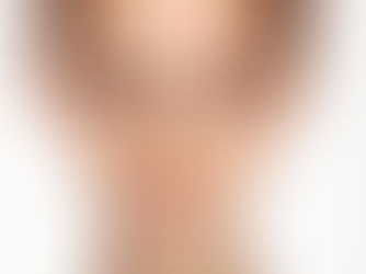 How much do you know about melasma?