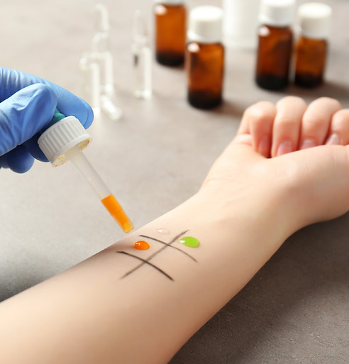 Allergy Skin Test