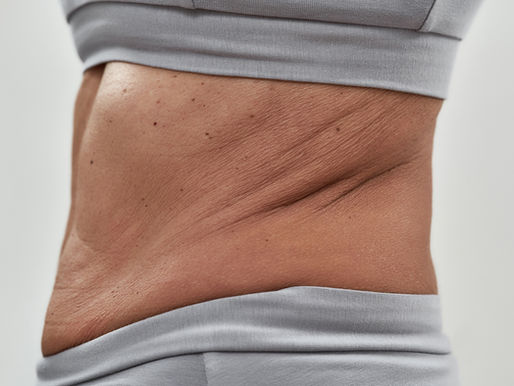 Is It Skin or Fat? Understanding the Difference After Weight Loss