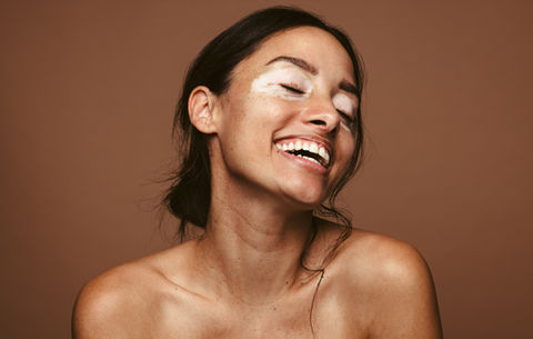 Vitiligo