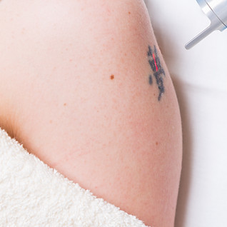Tattoo removal