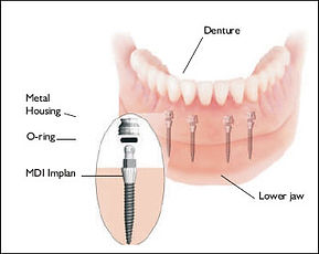 implant photo