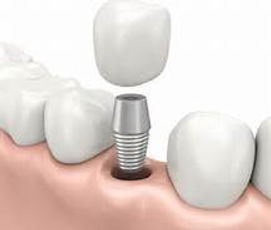 implant photo