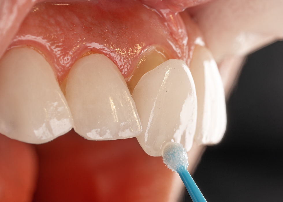 Patient getting dental veneer Austin, TX