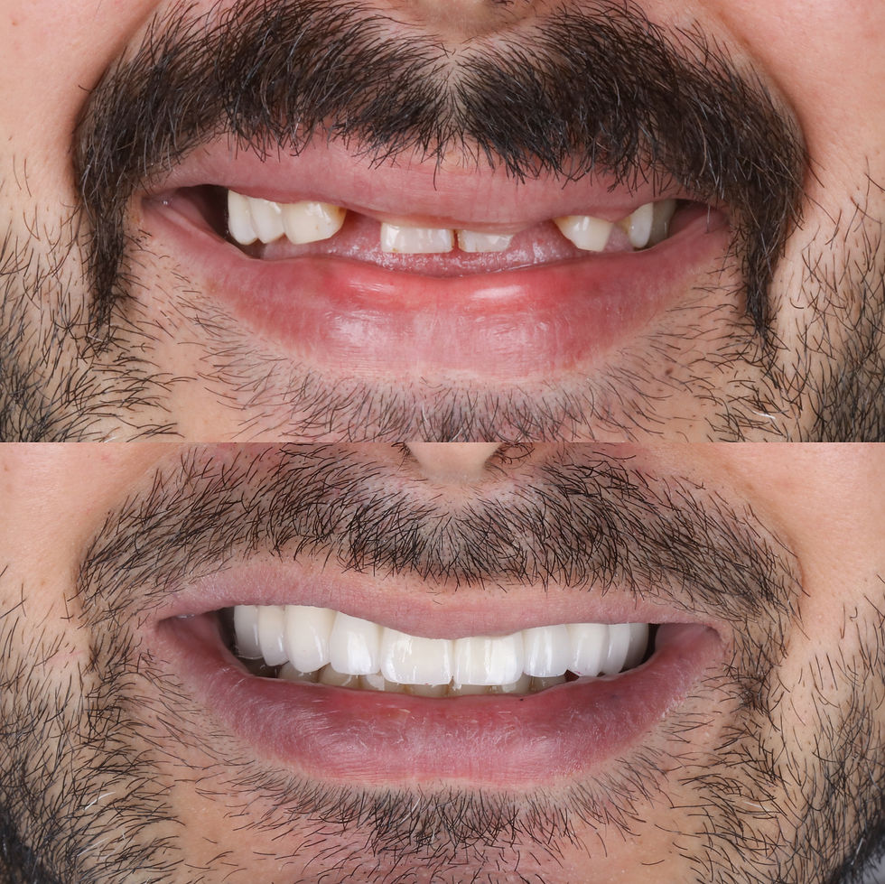 Before and after patient got dental bridge to replace missing teeth in Northwest Hills dentist
