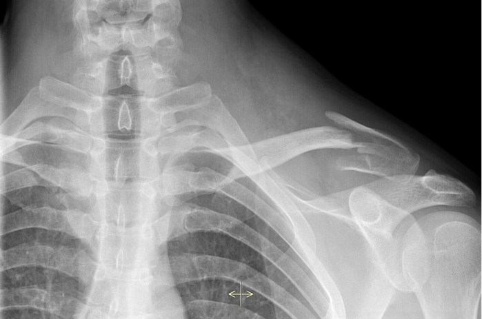 correção de fraturas curitiba.png