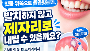 잇몸 위쪽으로 높게 올라온 송곳니 덧니, 발치 없이 교정할 수 있을까요? 김해 외동 미소치과에서 알려드립니다.