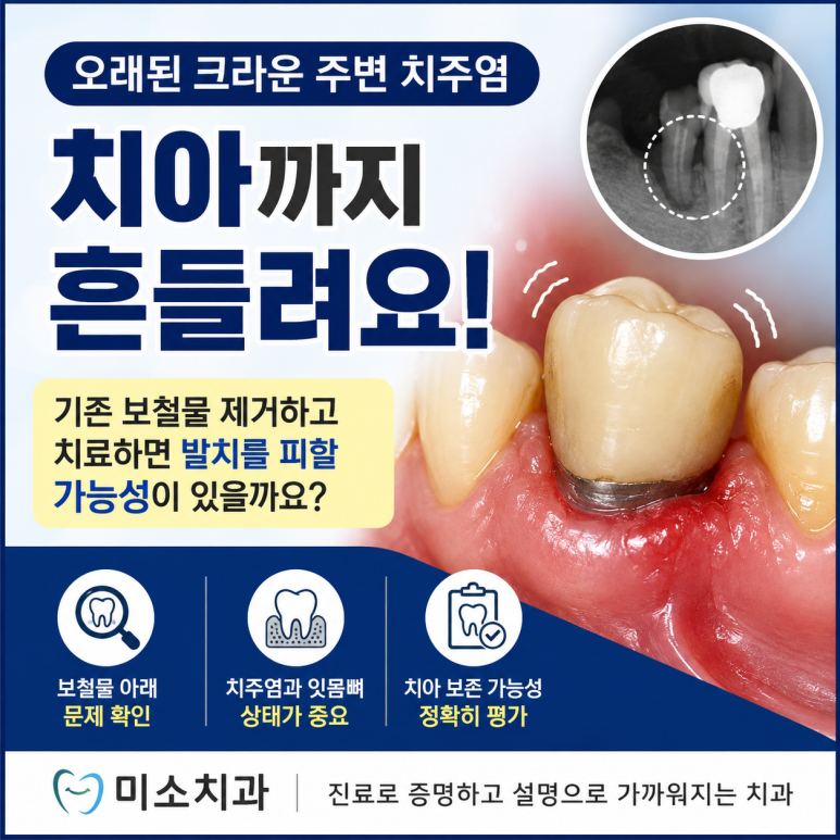 오래된 크라운 주변 치주염과 치아 흔들림, 보철물을 제거하면 발치를 피할 수 있을까요? 김해 외동 미소치과에서 알려드립니다.