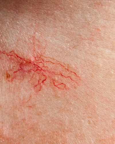 Visible broken capillary on facial skin