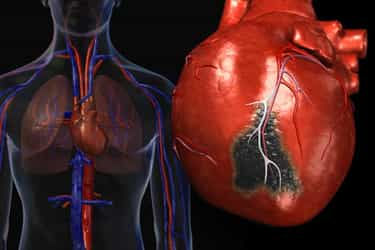 What's Heart Disease?