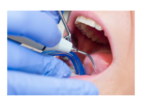 Close-up of a dental procedure, showing gloved hands using instruments inside an open mouth with visible teeth and gums. Blue dental tool.