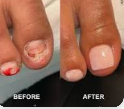 Nail Reconstruction
