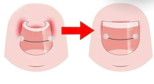 Nail Bracing