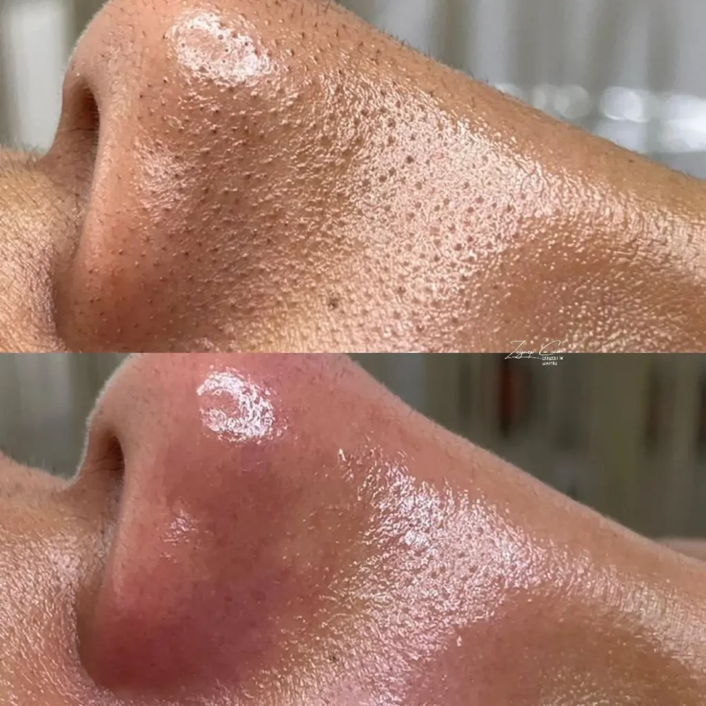 clean skin with facial blackheads large pores acne facial treatment