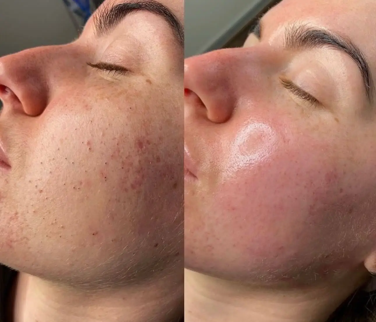 glowing glass skin facial anti aging anti acne treatment fine lines dark spots 