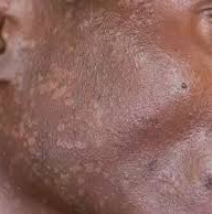 Seborrheic Dermatitis