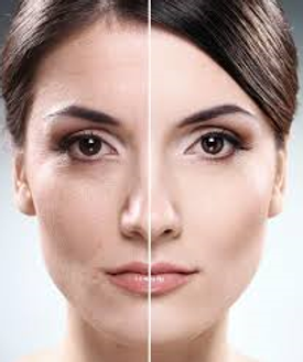 Laser Dermabrasion