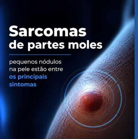 Sarcomas de partes moles: pequenos nódulos na pele estão entre os principais sintomas