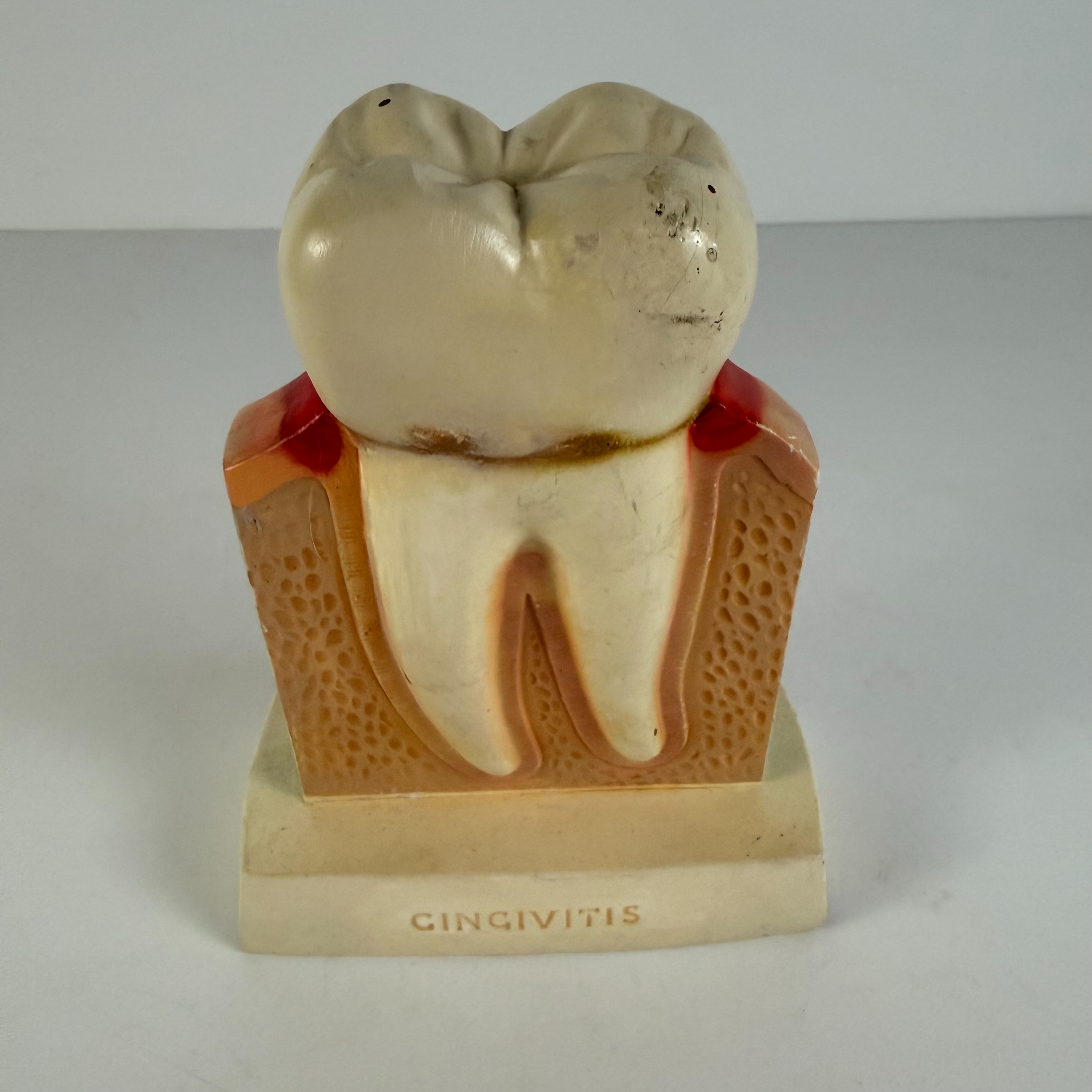 Gingivitis/Periodontal Tooth Anatomical Model