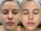Peeling peau Nice (06)