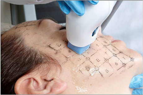 lifting sans chirurgie par thermage