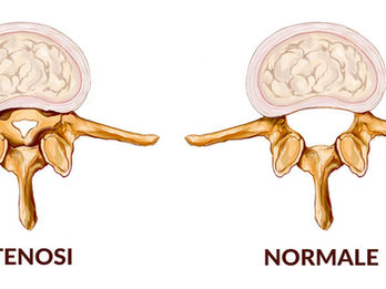 STENOSI LOMBARE E SCIATALGIE, SPONDILOLISTESI , DISORDINI DEGENERATIVI DEI DISCHI INTERVERTEBRALI