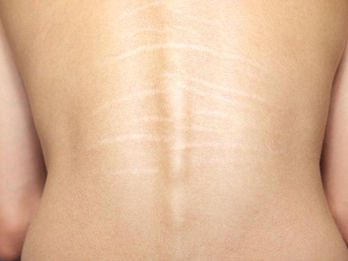 Come prendersi cura delle cicatrici post interventi di neurochirurgia vertebrale. Guida completa