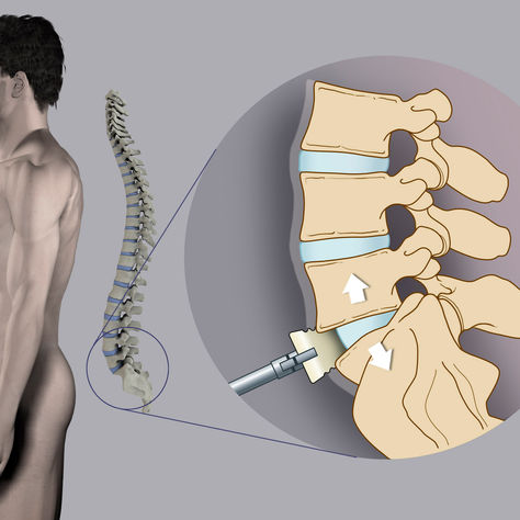 Tecniche mini-invasive per la colonna lombare: vantaggi, innovazioni e prospettive future della chirurgia vertebrale