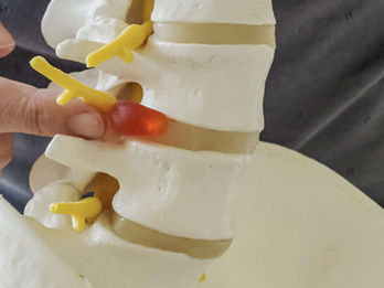 DISCOPATIA DEGENERATIVA, LE CAUSE, I SINTOMI, I RIMEDI, LA CHIRURGIA VERTEBRALE MININVASIVA.