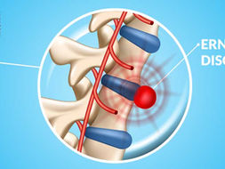 Ernia del Disco: Sintomi, Cause e Quando Intervenire
