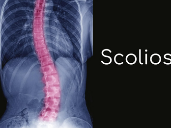 SCOLIOSI NEGLI ADULTI E NEGLI ANZIANI : L'IMPORTANZA DI UN INTERVENTO ESEGUITO DA UN NEUROCHIRURGO