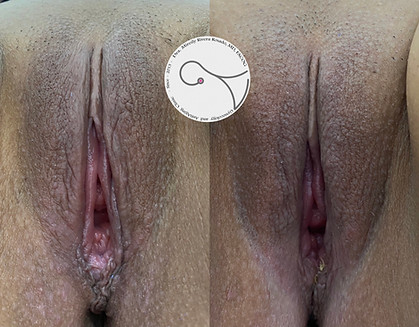 007 Cirugia Cosmetica Vaginal.jpg