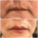 acido hialurónico en labios y zona peribucal