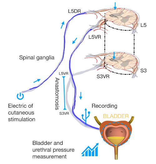 The Xiao procedure treats neurogenic bladder caused by various reasons.
