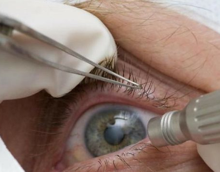 Causas PTERÍGIO-(carne-crescida).png